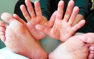 Новини Києва - У Києві фіксують спалах кору та гепатиту А