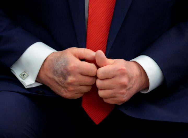 Новини світу - Повторні синці на руці: у США обговорюють здоров'я Трампа